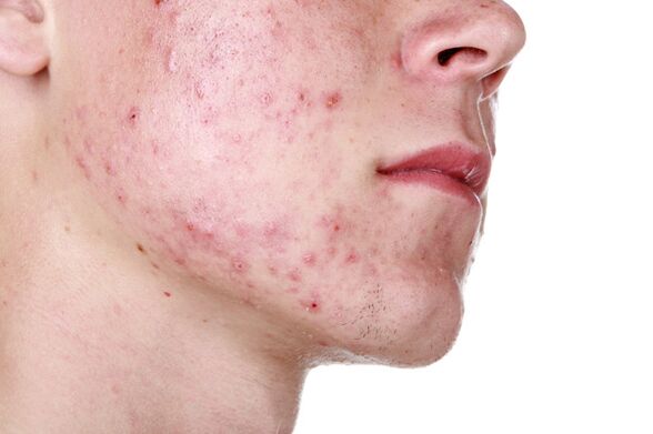 Lesões de pele facial com demodicose